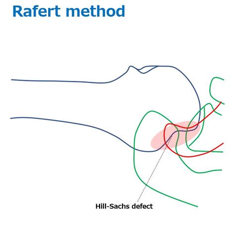 Shoulder Joint Axial View Superior Inferior Axial View Lawrence