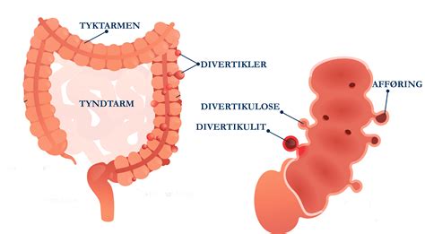 Divertikulose Er En Ukompliceret Udposning P Tarmen Ved Divertikulit