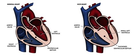 Cardiomyopathies American Heart Center Pc