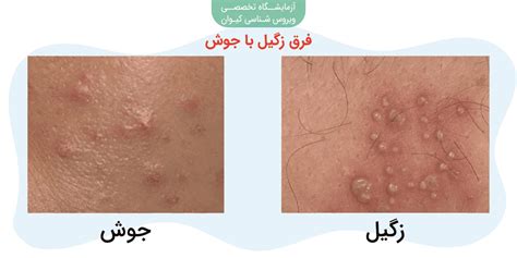 از کجا بفهمیم زگیل تناسلی داریم درمان چمدون