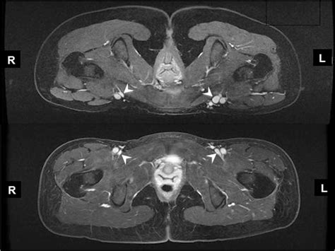 Pelvic Cardiovascular Magnetic Resonance Venography Venous Changes