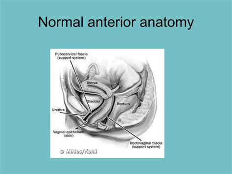 Pelvic Organ Prolapse Ppt