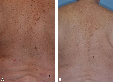 Primary Cutaneous B Cell Lymphomas Journal Of The American Academy Of Dermatology