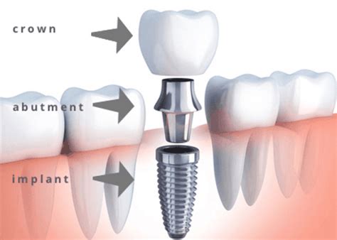 How To Understand Pros And Cons Of Dental Implants Vs Dentures