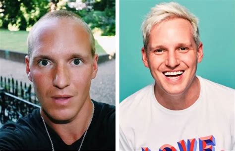 Jamie Laing Hair Transplant Everything You Need To Know