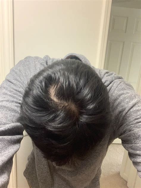 Diffuse thinning? : r/Hairloss