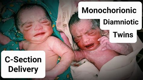 Twins C Section Monochorionic Diamniotic Twins Dr Tayyab Riaz Ch