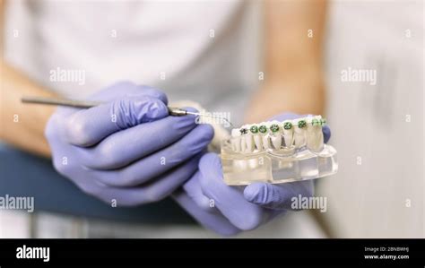 The Dentist Shows An Artificial Model Of The Jaw With Braces How To