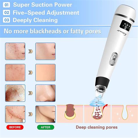 Blackhead Remover Pore Vacuum Cleaner Upgraded Facial Blackhead Remover