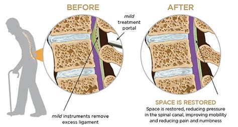 Minimally Invasive Lumbar Decompression | Kansas Pain Management | Kansas City