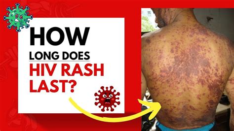 How Long Does Hiv Rash Last Youtube