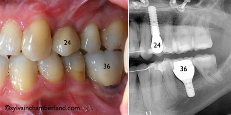 Mini vis d ancrage orthodontiste à Québec Dr Sylvain Chamberland