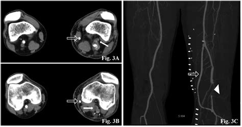 Treatment Failure After Rotational Atherectomy And Balloon Angioplasty