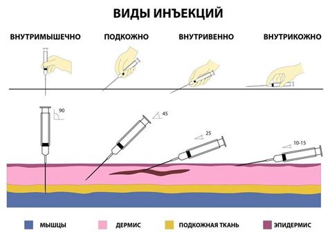 Уколы внутримышечно самостоятельно: Как сделать укол самому дома?