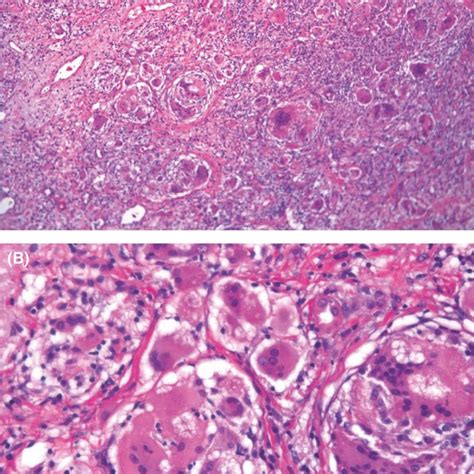 Pathological Examination Of The Specimen Using Thoracoscopic Lung