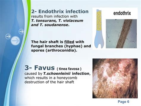 Tinea Capitis