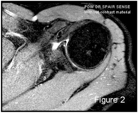 Mri Shoulder Dislocation