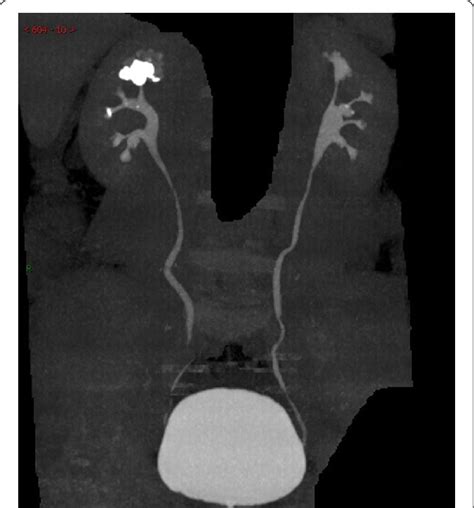 Preoperative CTU showed a 2.5 cm stone located in the upper pole calyceal | Download Scientific ...