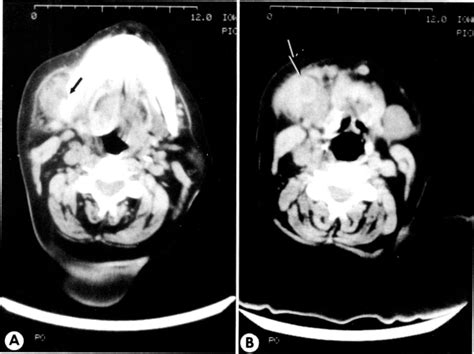 Figure 3 From Osteomyelitis Of The Mandible Simulating A Stafne Mandibular Cortical Defect