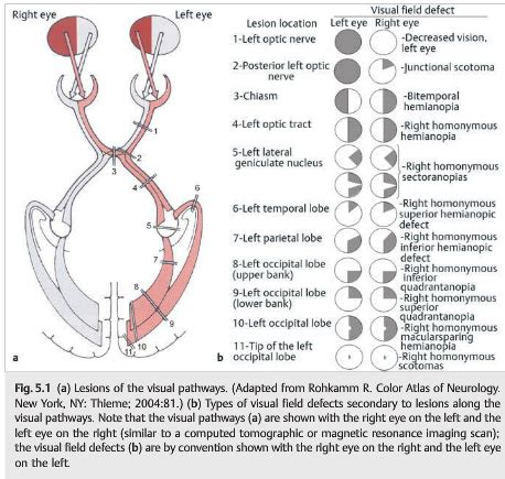 Neuro Ophthalmology Illustrated Chapter Vision Loss An Overview