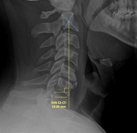 Subaxial Cervical Spine Plain Radiographs Clinical Tree