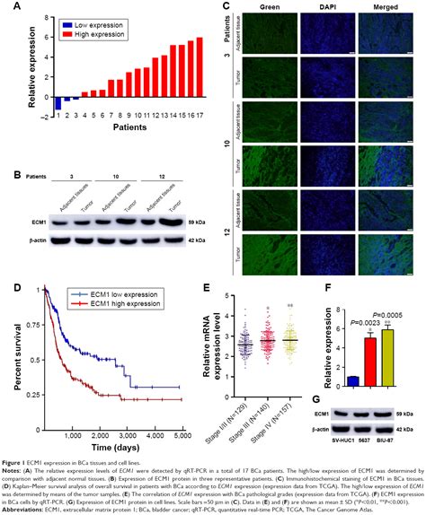 Extracellular Matrix Protein 1 ECM1 Is Associated With Carcinogenesi