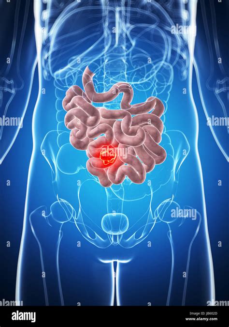 3d Rendered Illustration Of The Male Small Intestine Cancer Stock