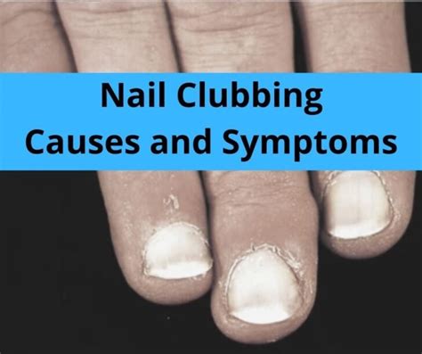 Nail Clubbing : Overview, Symptoms, and Causes