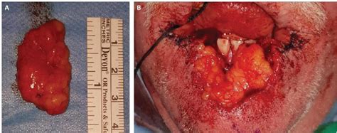 Figure 3 From Reconstruction Of The Lower Lip With A Buccal Fat Pad