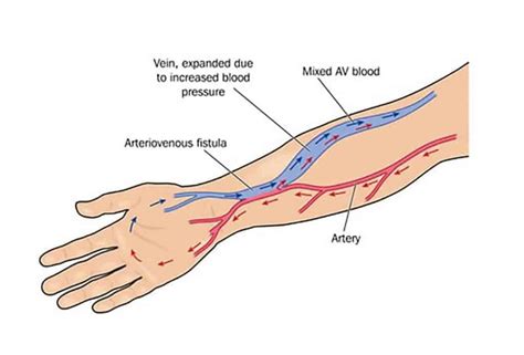 F Stula Arteriovenosa Para Hemodi Lise Saiba Mais Sobre Esse M Todo De