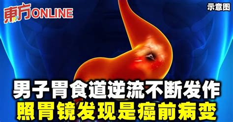 男子胃食道逆流不断发作 照胃镜发现是癌前病变 健康 生活 東方網 馬來西亞東方日報