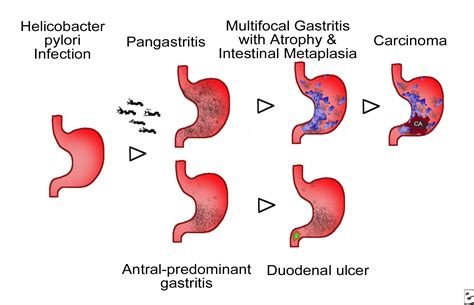 Gastritis, Atrophic