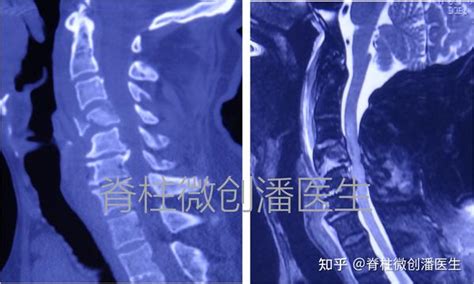 如何判断颈椎外伤后的瘫痪是否能恢复以及恢复程度？ 知乎