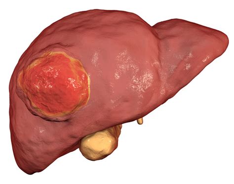 Liver Cancers House Medicine