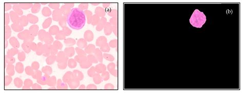 Atypical Lymphocytes Dengue