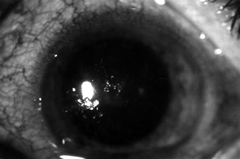 Acanthamoeba Keratitis Occurring With Daily Disposable Contact Lens Wear British Journal Of