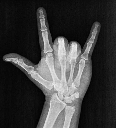 Film Xray X Ray Or Radiograph Of Hand And Fingers Showing Skeleton