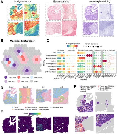 The Crosstalk Role Of Cdkn A Between Tumor Progression And Cuproptosis