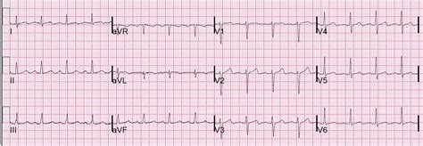 Dr. Smith's ECG Blog: Dynamic T-wave inversion (apparent Wellens' waves), all troponins negative ...