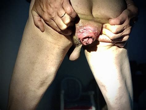 Dilatation And Anal Prolapse 12 Pics XHamster