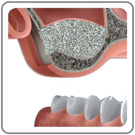 Knochenaufbau Implantologie Leistungen Zahnarzt Hildesheim Dr