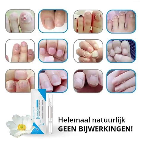 Schimmel Reliëf Behandeling Pen DrHealthyMe NL Gezonde nagels