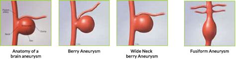 Aneurysm Dr Shripal Shah