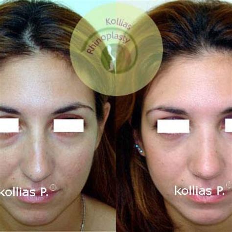 Rhinoplasty Nasal Tip Ptosis 036 Π Κόλλιας