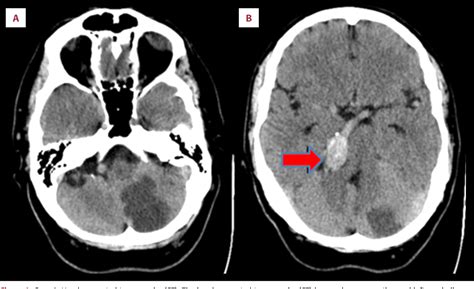 Pdf Acute Bilateral Ophthalmoplegia Due To Vertebrobasilar