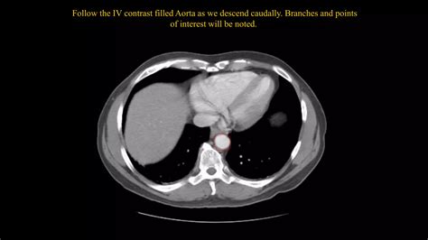 Abdominal CT scan | PPT