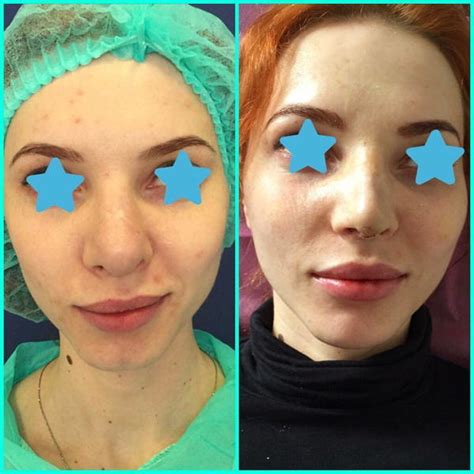 Bulbous Nose Repair Before And After » Rhinoplasty: Cost, Pics, Reviews, Q&A