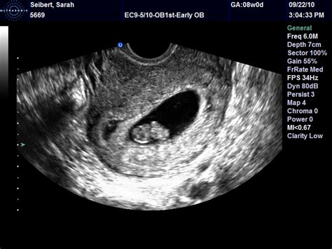 Our Marathon to a Family: 8 Week Ultrasound