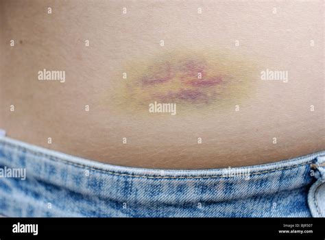 Bruising around the kidney area on a woman's back Stock Photo - Alamy