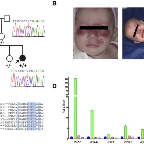 Clinical Presentation And Genetic Findings In PSMB10 PRAAS A Pedigree